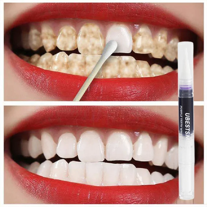 S6c4fc57c73cd44738dc4ee00cfeca7daH.webp Nettoyage des dents, élimination des taches